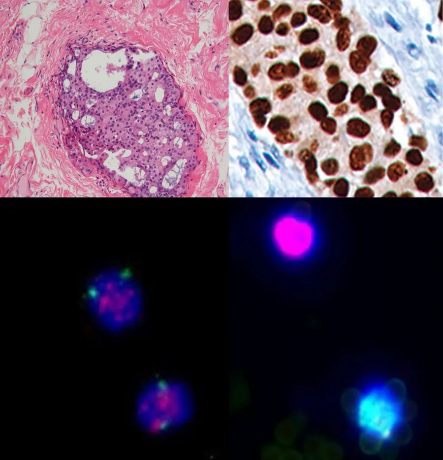 Pathological evaluation of a breast biopsy